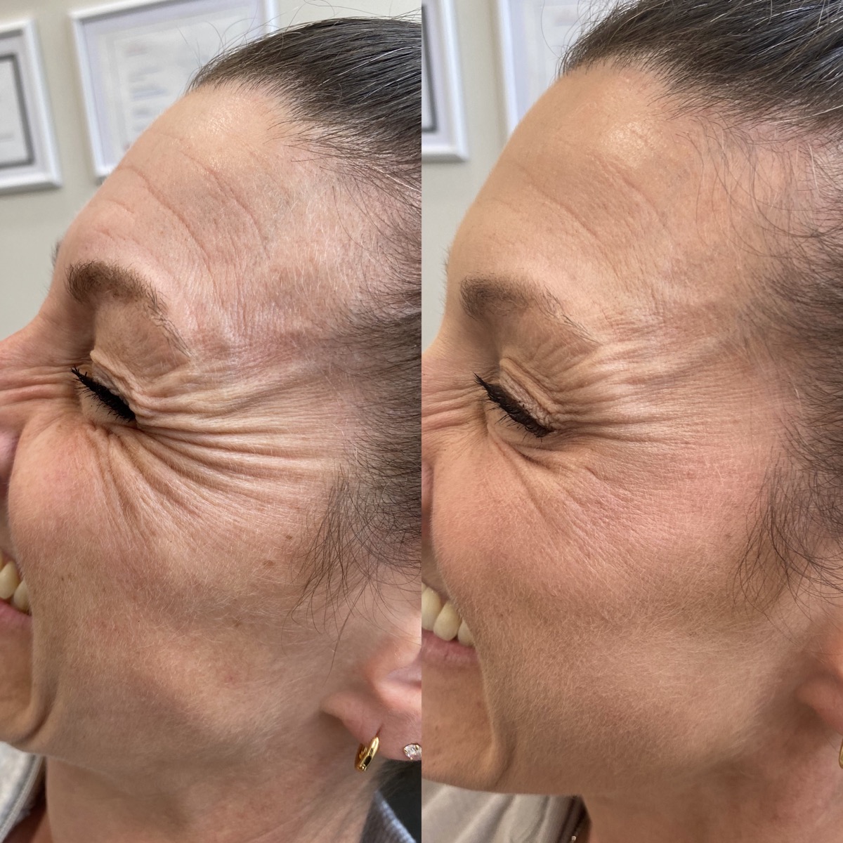 Botox before and after result 1