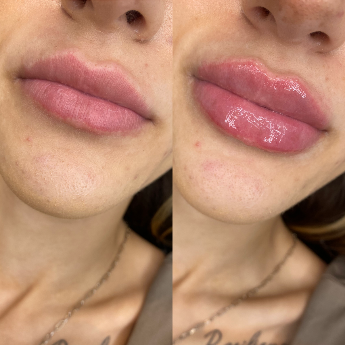 Injectables client results 2