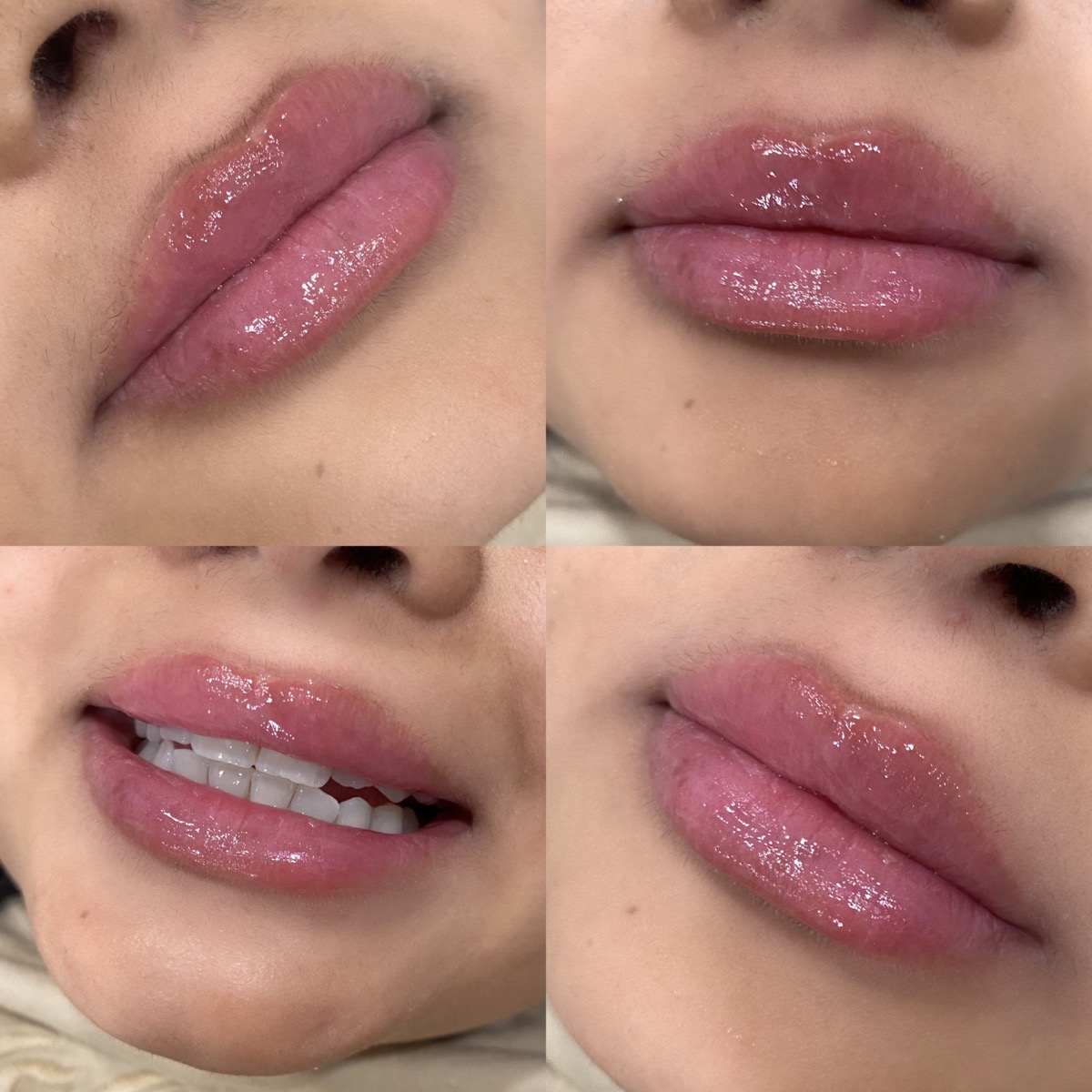 Injectables client results 3