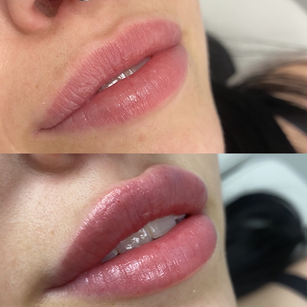 Lip Fillers before and after result 6