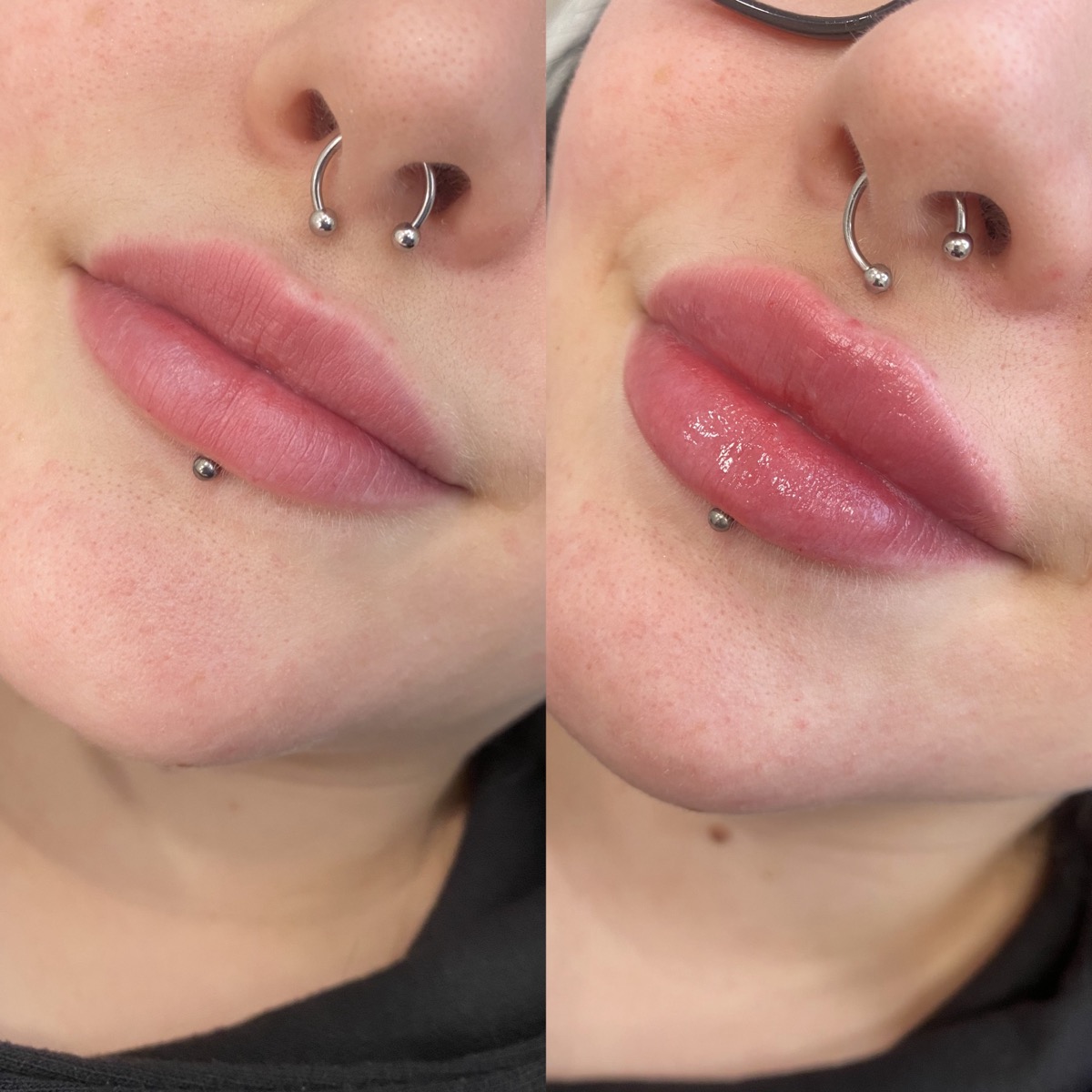 Lip Fillers before and after result 7