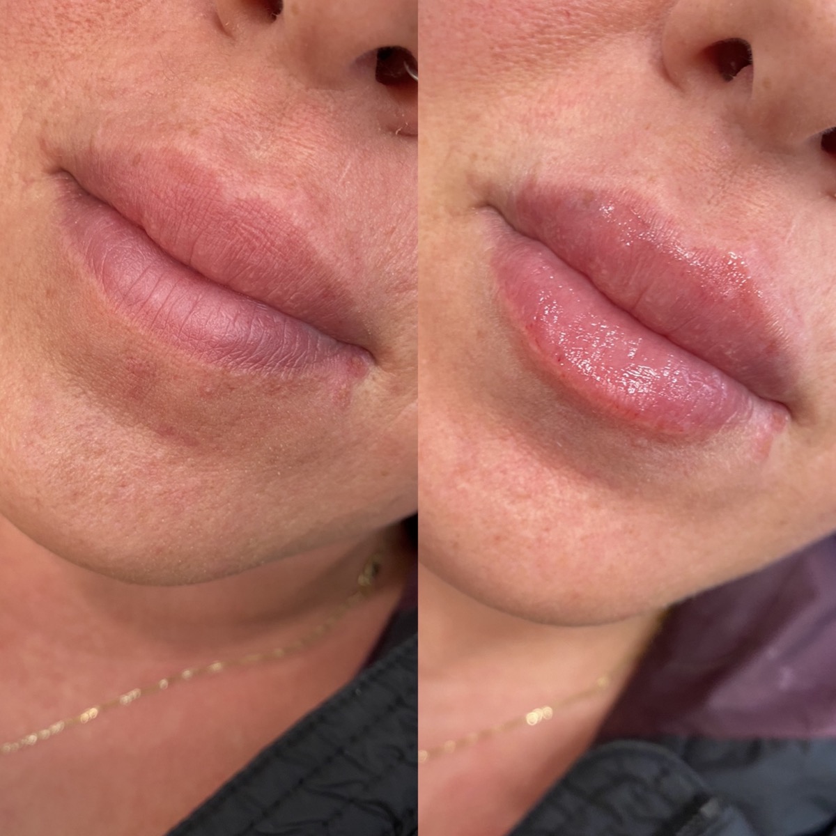 Lip Fillers before and after result 8