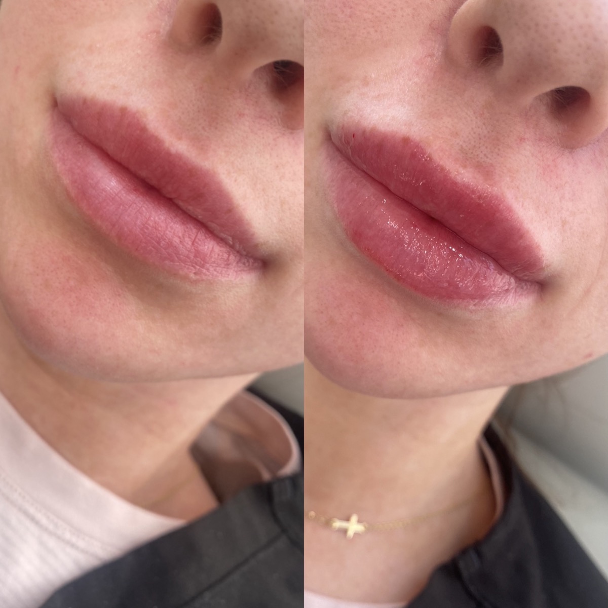 Lip Fillers before and after result 9
