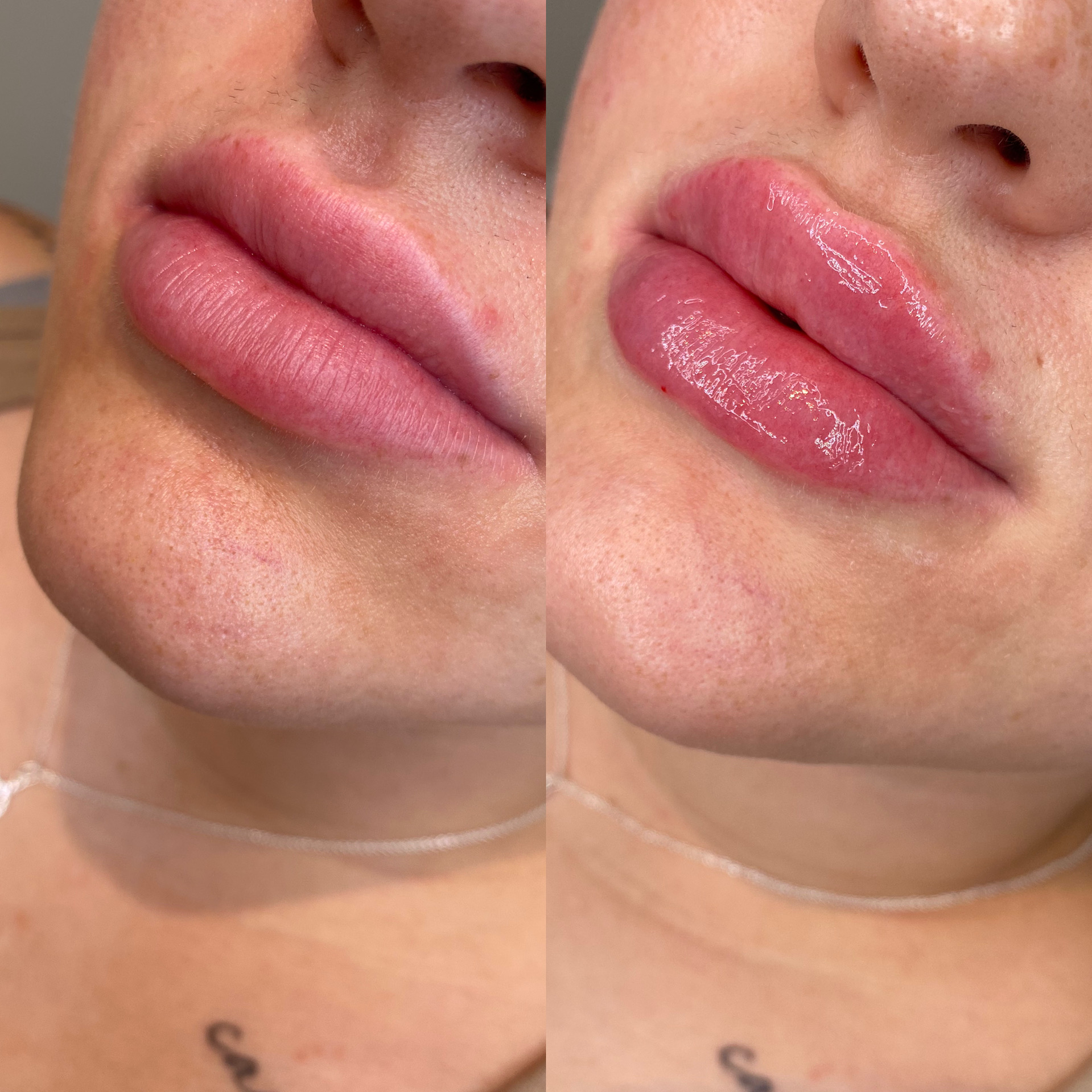Lip Fillers before and after result 10