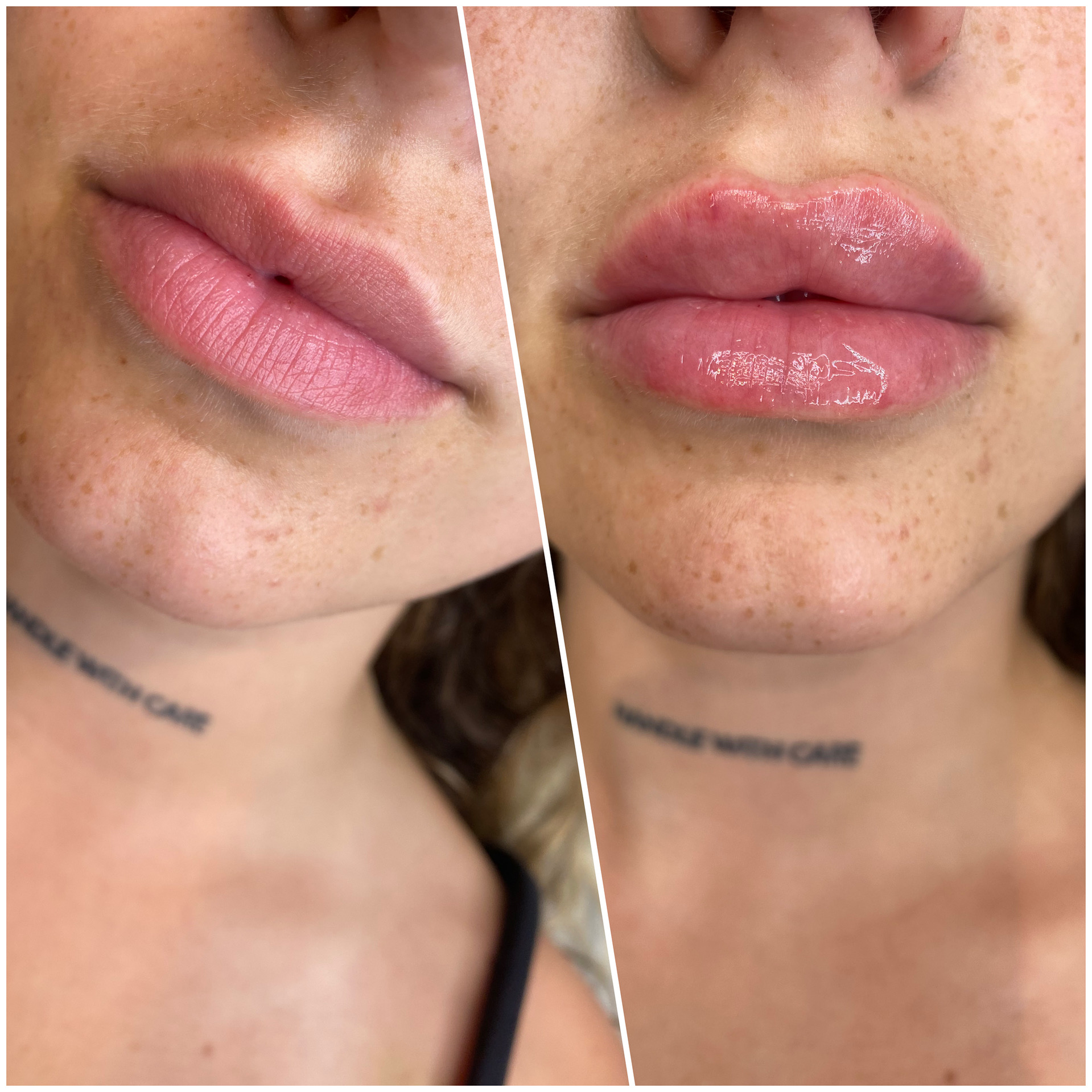 Lip Fillers before and after result 11